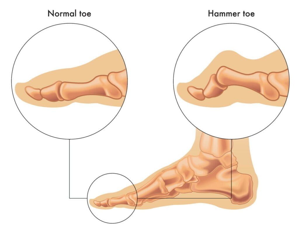 Hammertoes – bent toes and treatment
