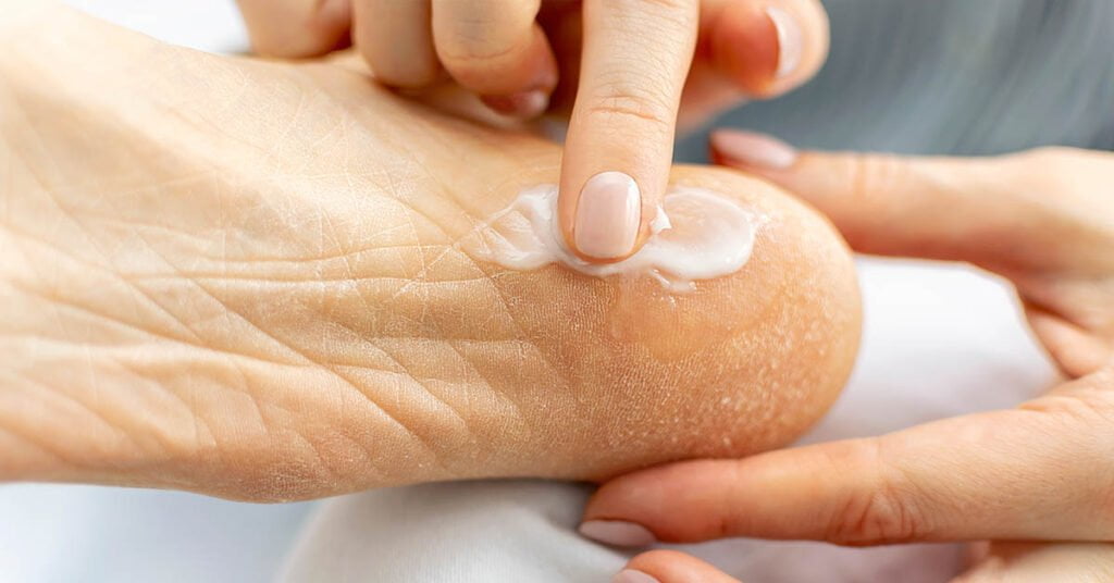 Treating heel cracks – moisturising and removing callus