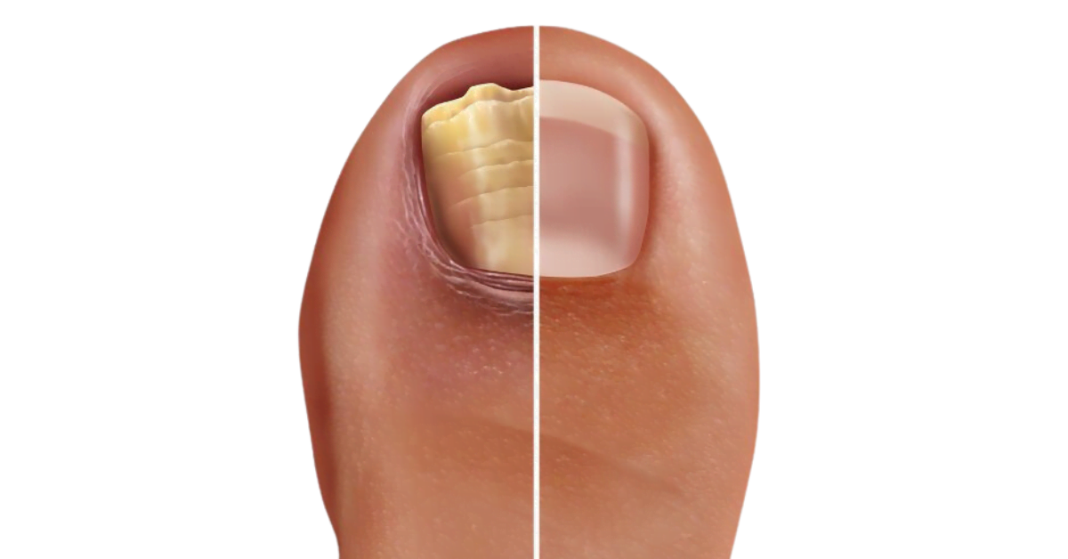 Fungal nail infection (toenail fungus) on the toe