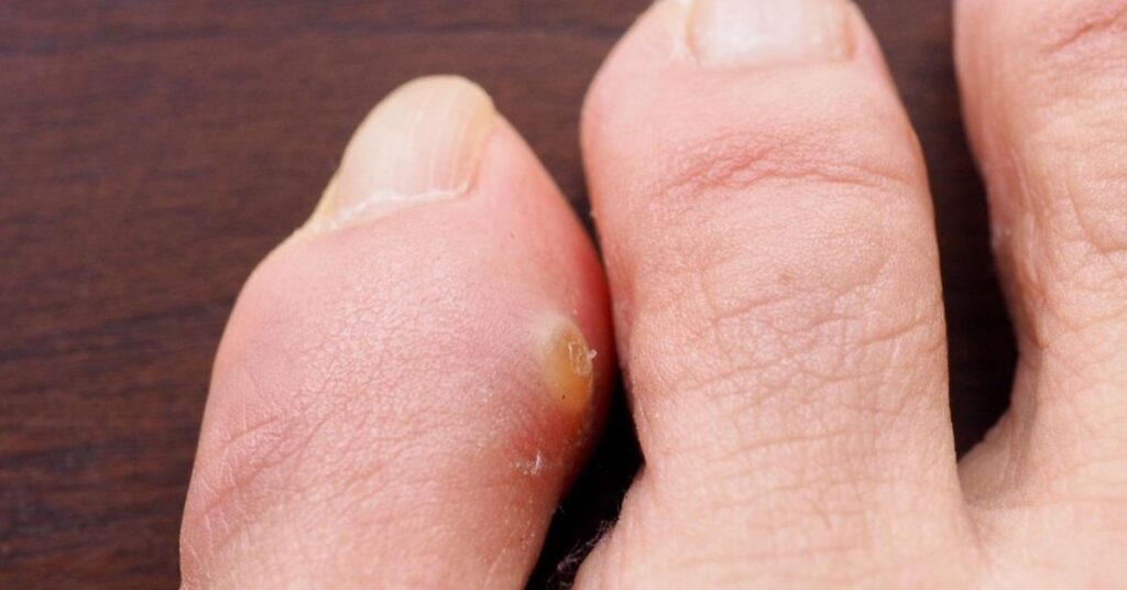 Corn treatment – pedicure and prevention