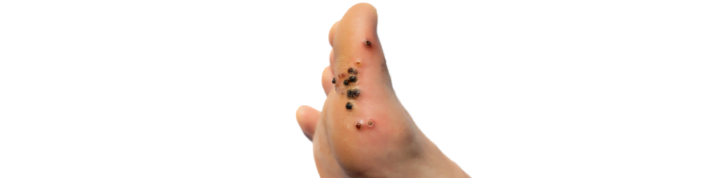 Plantar Wart – verruca plantaris on sole of foot