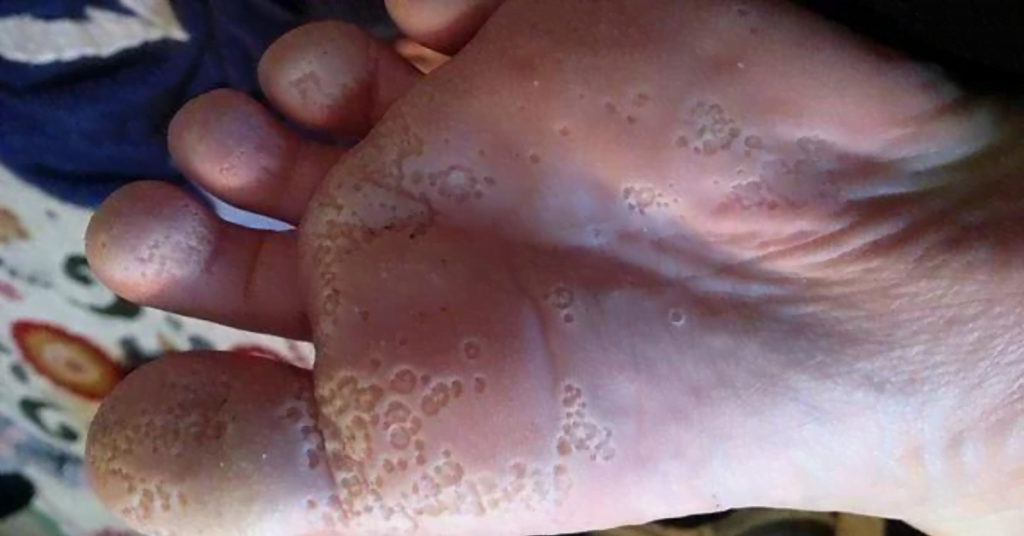 Sole of the foot with pitted keratolysis